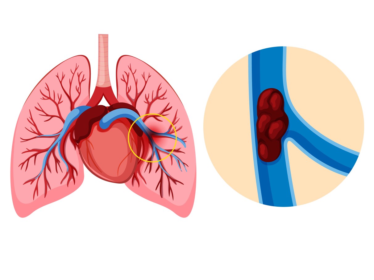 o-que-e-embolia-pulmonar